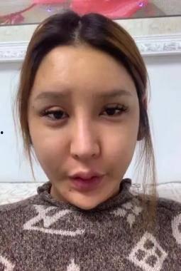 整容失败脸很鼓的网红吃瓜,美丽代价太大！